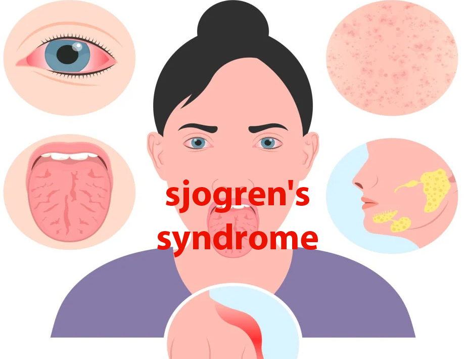 sjogren's syndrome